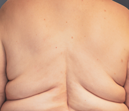 Patient after, week 16, back image