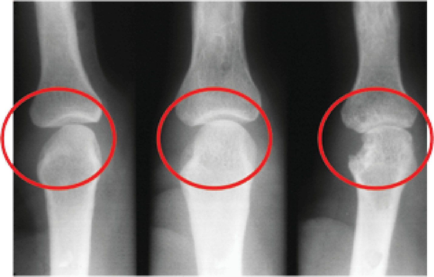 X-ray of bones