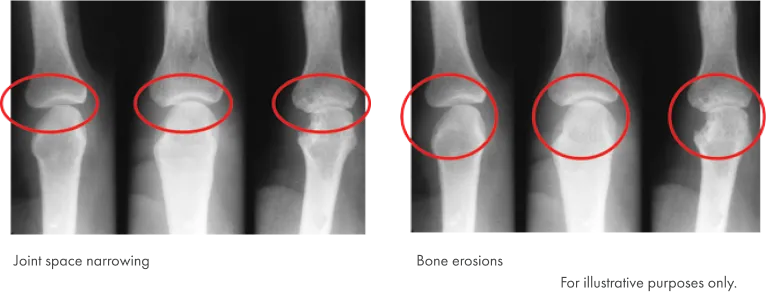 X-Ray Image of the joint space narrowing and X-Ray Image of bone erosions.