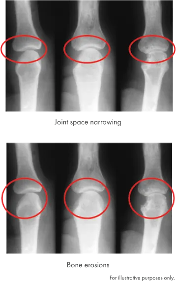 X-Ray Image of the joint space narrowing and X-Ray Image of bone erosions.