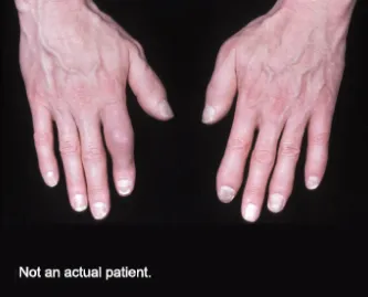 Dactylitis Resolution