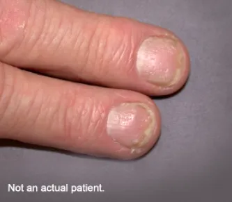 nail psoriasis resolution